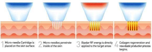 عمق سوزن دستگاه آر اف فرکشنال سوزنی